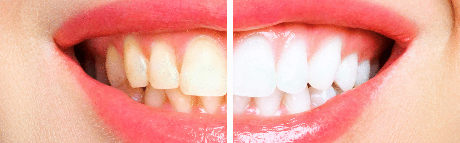 Bridal Dental Makeup in Ludhiana, Bridal Dental Studio Ludhiana, Wedding Smile Makeover Ludhiana, Bridal Dental Care Ludhiana, Cosmetic Dentistry for Brides in Ludhiana, Ludhiana Bridal Smile Enhancement, Pre-Wedding Dental Services Ludhiana, Bridal Teeth Whitening Ludhiana, Tooth Jewelry Ludhiana, Bridal Dental Accessories in Ludhiana